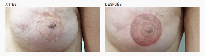 tatuaje oncológico médico Micropigmentación de areolas mamas en Logia Barcelona