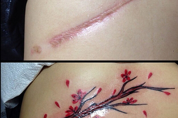 Tatuajes sobre cicatrices y lunares