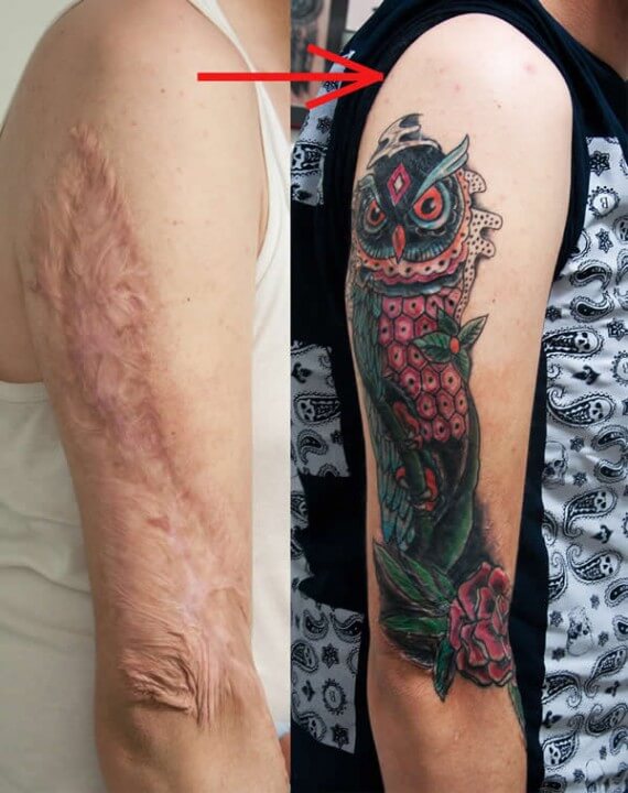 Tatuajes sobre cicatrices y lunares - | Tatuajes Logia ...