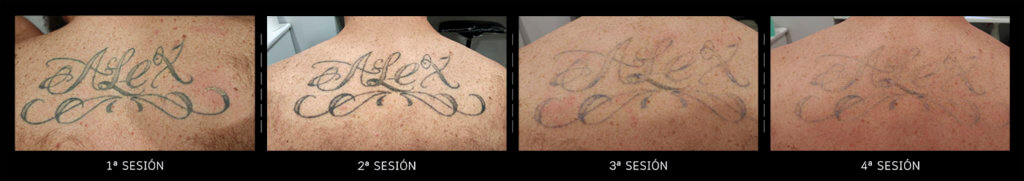 cover tattoo - tattoo removal